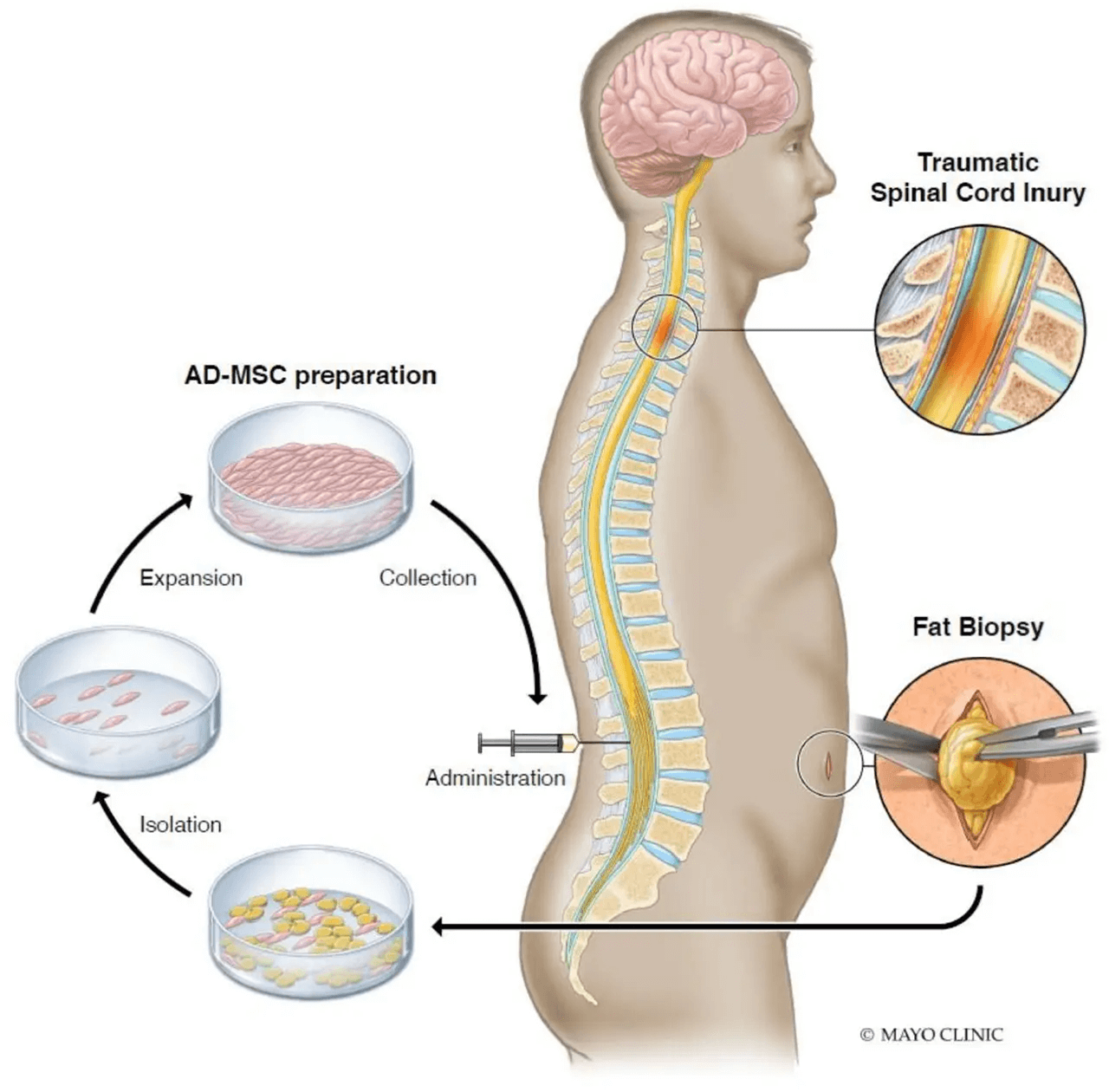 Spinal cord injury stem cell therapy