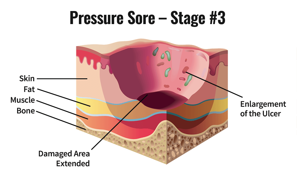 Pressure Sore Stage #3