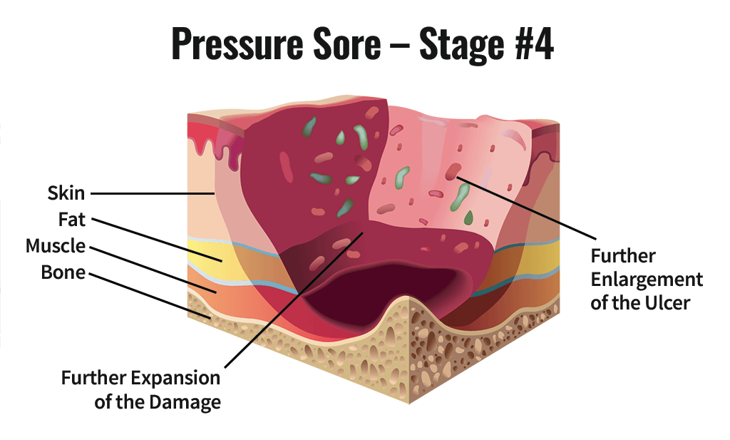 Pressure Sore Stage #4