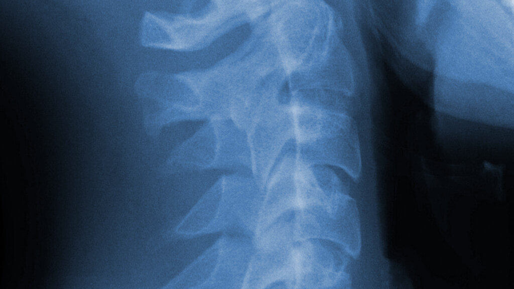 X-ray of the Spine
